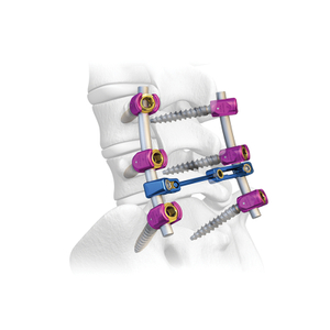 6.0 Système de vis pédiculaire spinale